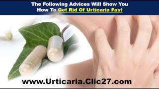 How To Get Rid Of Urticaria | How To Get Rid Of Urticaria Fast