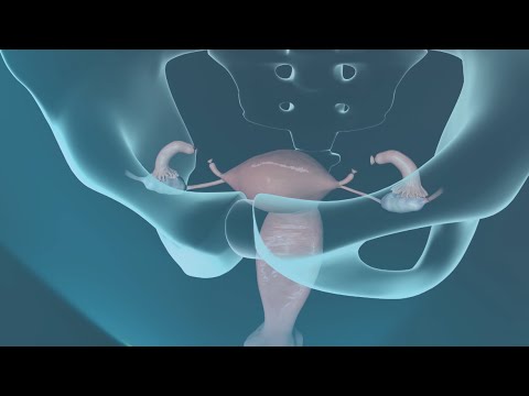 Tubal Ligation Surgery