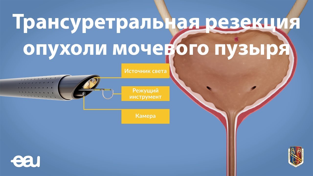 Шейка дивертикула мочевого пузыря. Внутрипузырная химия мочевого пузыря. Тур мочевого пузыря у мужчин что это. Тур мочевого пузыря у мужчин что это. Устье мочевого пузыря анатомия.