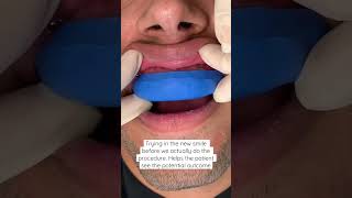 Trial smile veneers | porcelain veneers procedure | porcelain veneers for gapped teeth | Dr. Yazdan