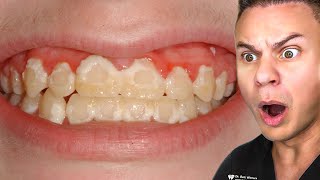 All Your Braces Pain In One Video