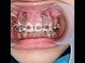 Gummy smile treatment with mini implant, upper incisors intrusion with orthodontic mini screw