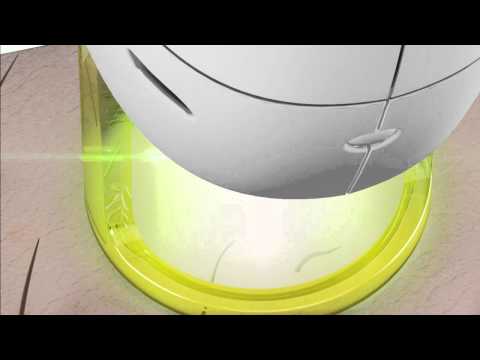 Gentle MaxPro Laser Hair removal at Prima Britannia Laser Clinic