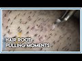 Hair Root Pulling Moments HAIR TRANSPLANT SURGERY