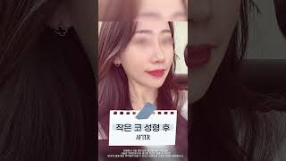 코 유형별로 알아보는 코성형 핵심 point!
