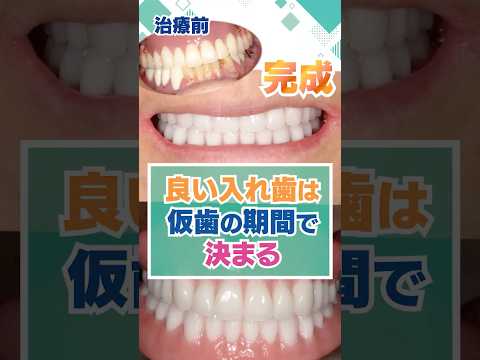 良い入れ歯は、仮歯の期間で決まります