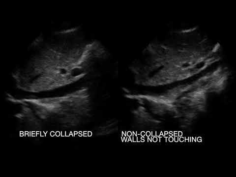 Mostly, Briefly and Non-Collapsed IVCs in 14 y.o. Boy