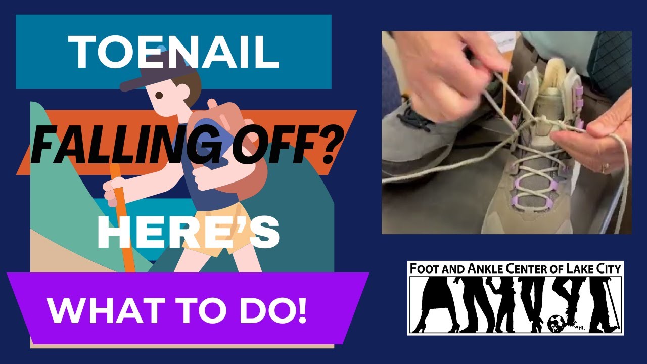 Toenail Falling Off On a Hike? Here's What To Do! Foot and Ankle