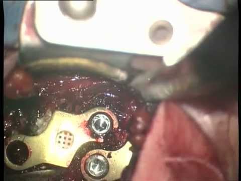 È stato rimosso come liquido dal fianco Mal di schiena da progetto