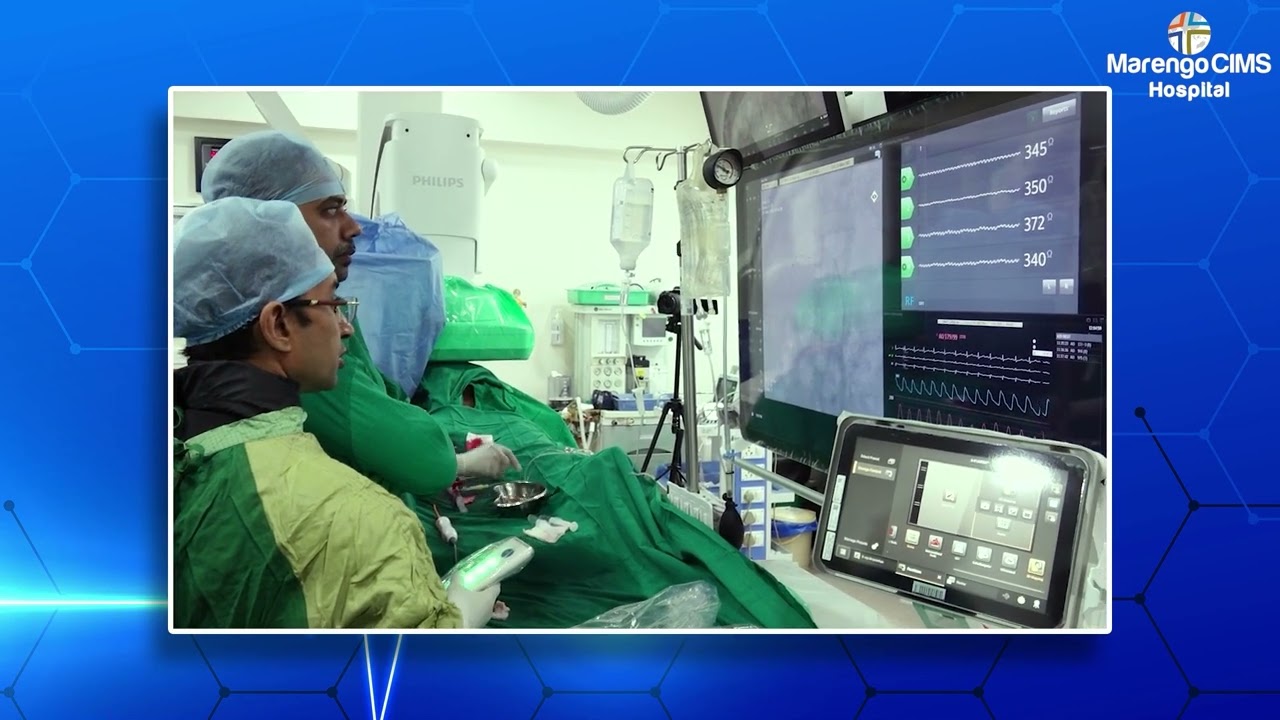 Step by step approach to Renal Denervation using Medtronic's Symplicity Spyral RDN catheter