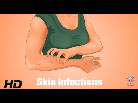 Skin Infections Uncovered: What Your Dermatologist Wants You to Know