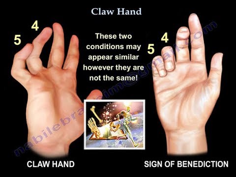 , title : 'Claw Hand, Ulnar Claw Hand - Everything You Need To Know - Dr. Nabil Ebraheim'