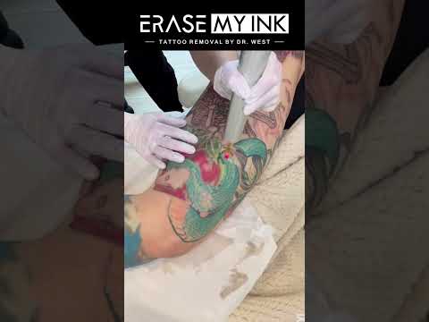 Tattoo removal video case 9