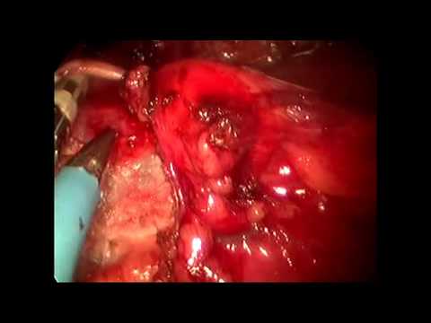 Single Port Laparoscopic Gelpoint Nephrectomy