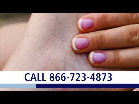 What causes varicose veins? Penn State Health St.
