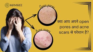 How to Treat Open Pores and Acne Scars | खुले छिद्रों और मुँहासों के दागों का इलाज कैसे करें