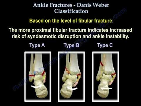 Ankle Fractures Danis Weber Classification - Everything You Need To Know - Dr. Nabil Ebraheim