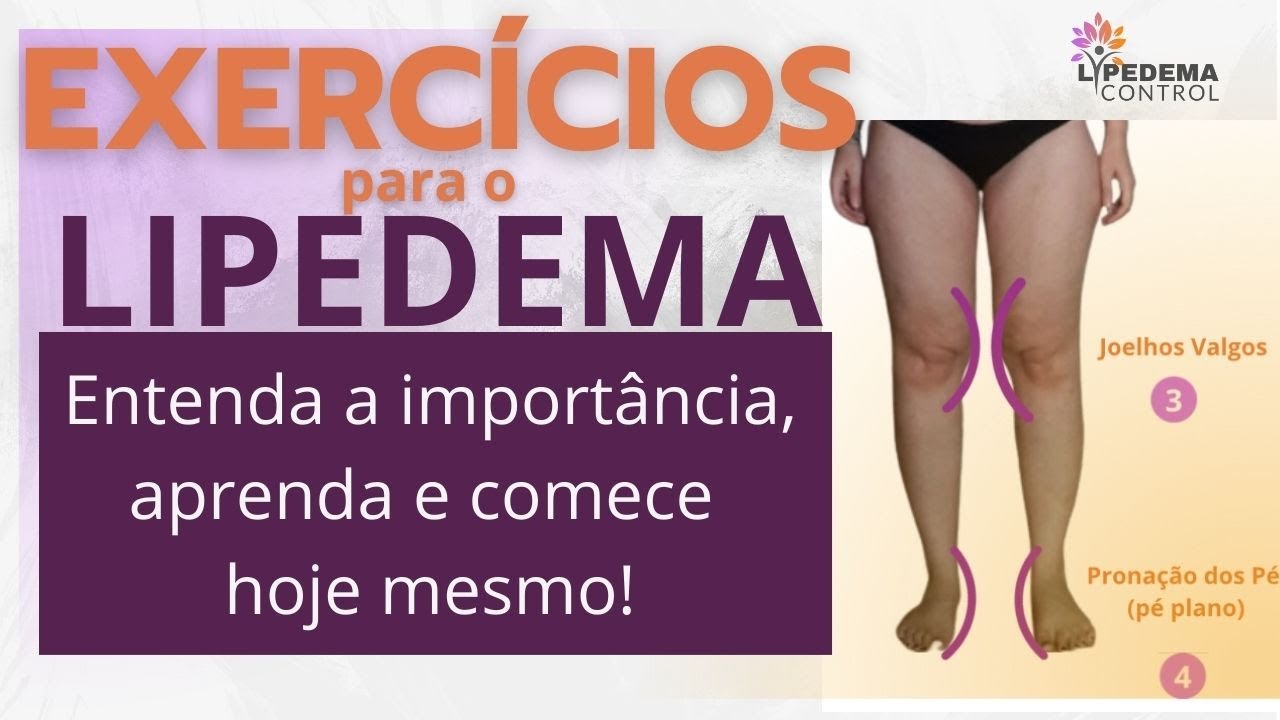 Exercícios para Lipedema! Aprenda e comece hoje mesmo!