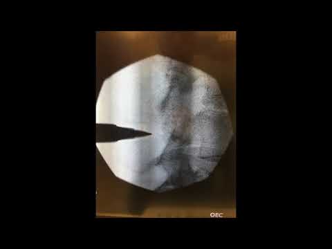Dr Skaribas - Expert Pain Vertiflex instructional video EC064BEF 035D 42AD B726 C8E