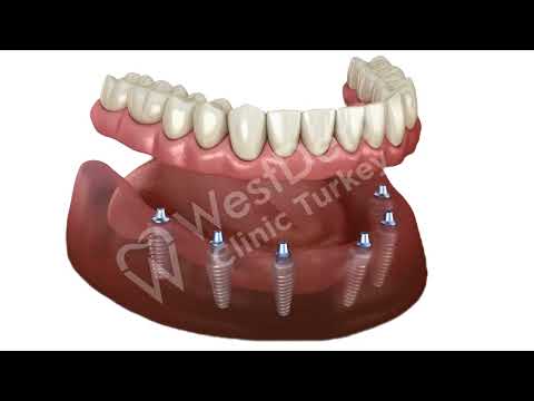 Logo of Complete Guide to the All-on-6 Dental Implants Procedure in Turkey