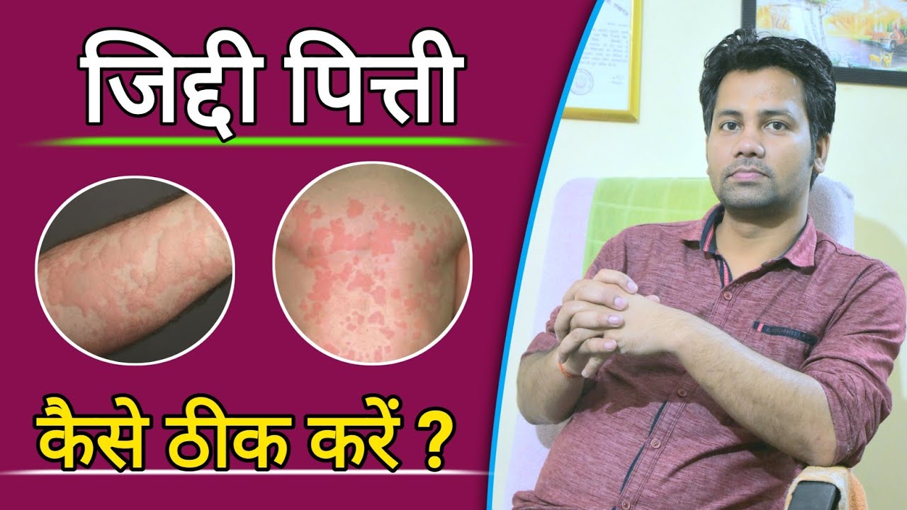 Watch video पित्ती , खुजली , जलन | Charak Pharma Urtiplex Capsule for Urticaria | Dr tarun Now पित्ती , खुजली , जलन | Charak Pharma Urtiplex Capsule for Urticaria | Dr tarun