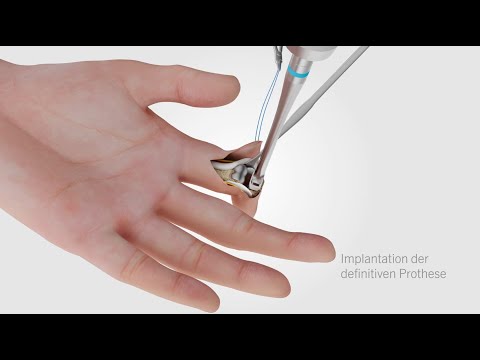CapFlex PIP – Endoprothetische Versorgung des proximalen Interphalangealgelenks (palmarer Zugang)