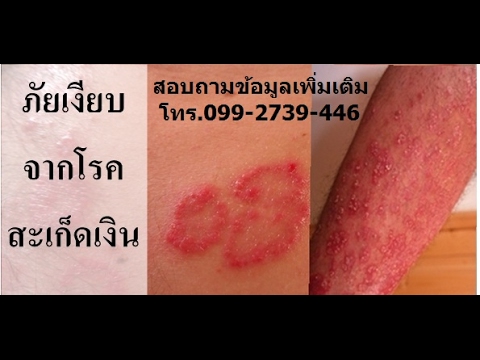 แผนการกลากแห้ง คนที่มีโรคสะเก็ดเงินเป็นพิเศษ