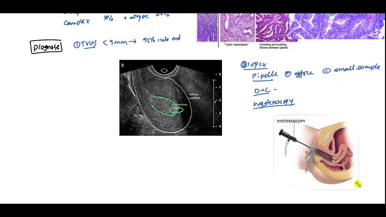 Endometrial Cancer and Hyperplasia for USMLE - YouTube