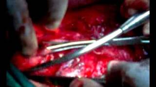preview picture of video 'Teratoma mediastinum surgery 1 _ 3gp'