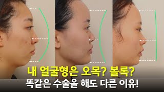 같은 수술인데 왜 나는 효과가 없을까? 오목형 볼록형! 이걸 알아야 성공한다! #프로필라인
