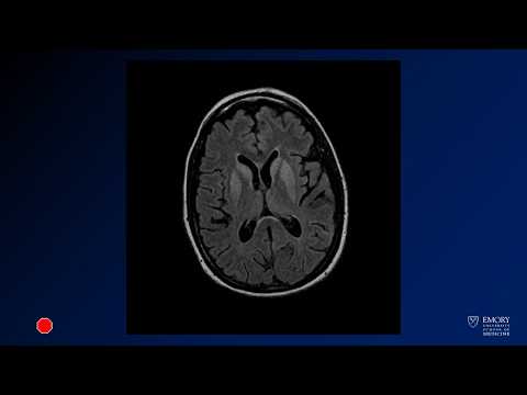 Neuroradiology board review lecture 1 case 4