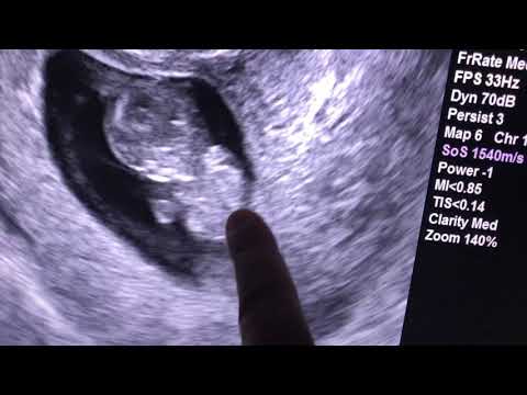 Sonogram: 10 weeks pregnant....and twins too!