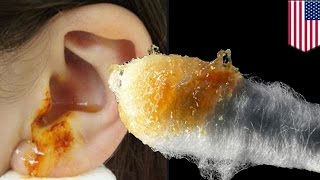 Removing ear wax: Cleaning ears with a Q-tip is bad for you, bad for ear health - TomoNews