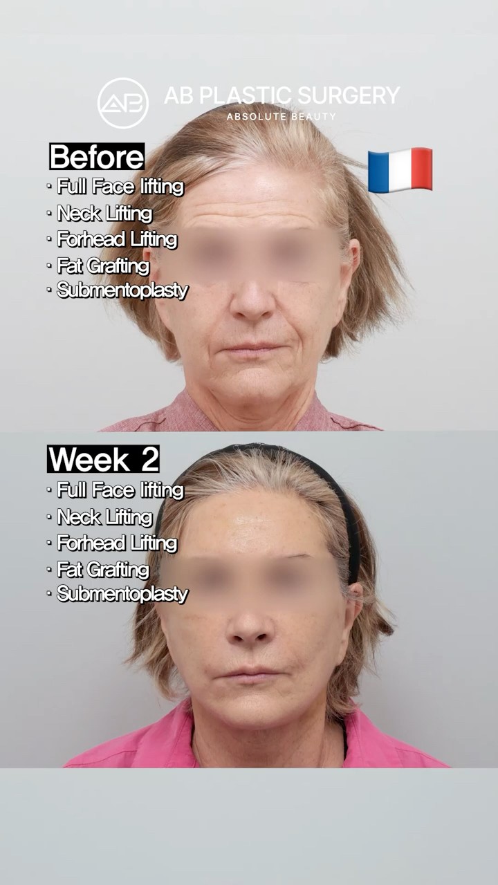 14 Days After a Facelift in Korea