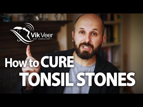 Treatment for Tonsil Stones