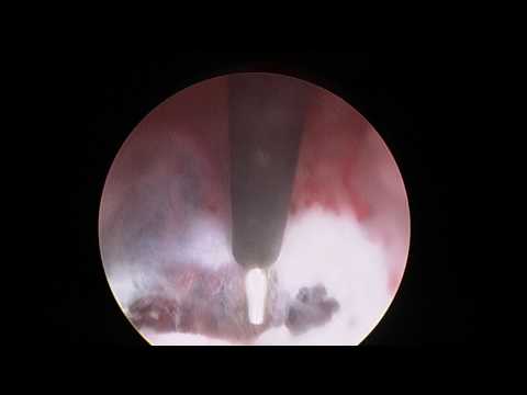 Endoscopy of the Brain - Brain Biopsy