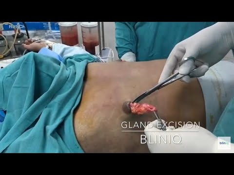 Patient Recovery Case — Video 22 (Liposuction)