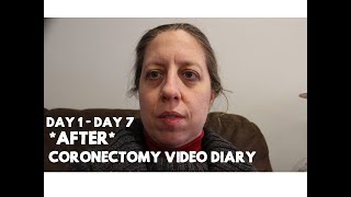 Post Coronectomy Video Diary: Day 1 to Day 7