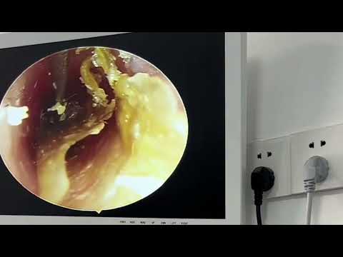 Ear Wax Removing, Earwax Removal, Ear cleaning