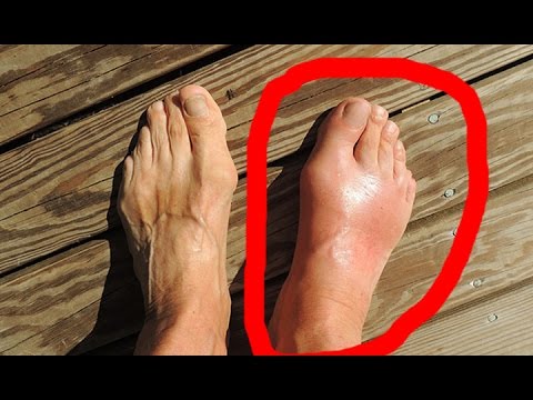 Kung upang payagan ang work kung may kuko halamang-singaw Paa halamang-singaw paa at toes Litrato Paa