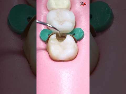 Perfect Cavity Filling #Satisfying #asmr