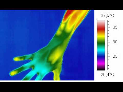 comment traiter le syndrome de raynaud