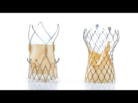 Transcatheter Mitral Valve Replacement: Valve-in-Valve, Valve-in-Ring, and Valve-in-MAC