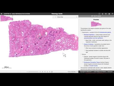 Radiculitis prosztatitis