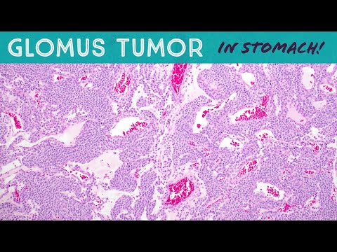 Glomus Tumor (in STOMACH!)(soft tissue pathology gastric/gastrointestinal tumor)