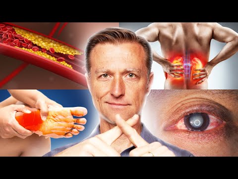 Does Stevia Affect your Blood Sugar – Dr Berg