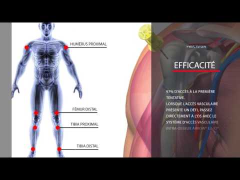 The Arrow® EZ-IO® Intraosseous Vascular Access System