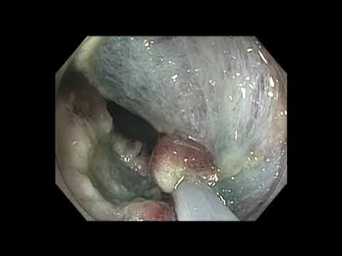 Colonoscopia - RME de LST-NG del colon descendente - trayectoria: adenocarcinoma