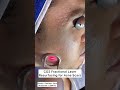 CO2 Fractional Laser Resurfacing for Acne Scars #shorts