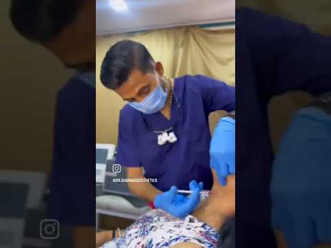 Liposuction (Non-surgical) Double chin removal